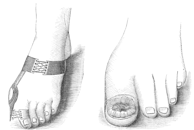 Schwarze und weiße Zeichnung eines Paares Füße, einer mit einem Verband und der andere mit einer Fraktur, mit Text unten.